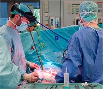Real-time 3D scans of cardiac surgery using a single optical-see-through head-mounted display in a mobile setup